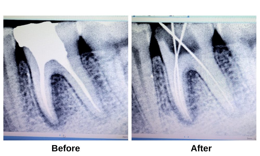 Best Root Canal Dentist Near Sangavi, Pimple Saudagar, Kasarwadi, Pimple Gurav