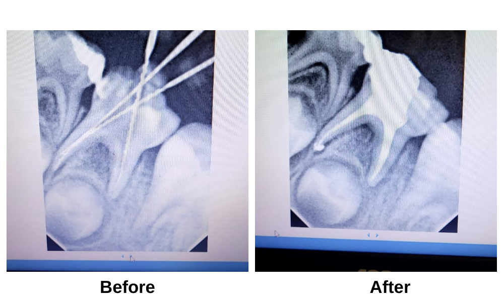 Painless Root Canal Treatment Near Sangavi, Pimple Saudagar, Kasarwadi, Pimple Gurav