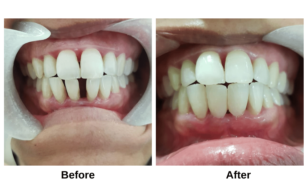 Best Smile Design Dental Clinic In Sangavi, Pimple Saudagar, Kasarwadi, Pimple Gurav