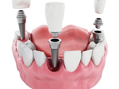 Teeth Implants Treatment Near Sangavi, Pimple Saudagar, Kasarwadi, Pimple Gurav